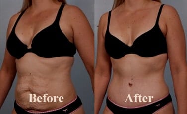 Abdominoplasty Indore Before After