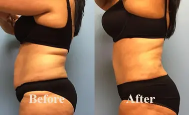 Abdominoplasty Tummy Tuck Before After