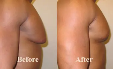 Male Breast Liposuction Before After