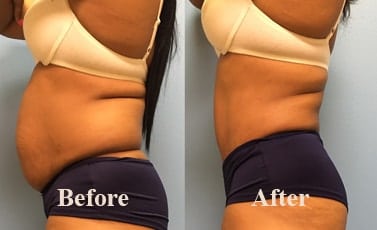 Stomach Liposuction Indore Before After