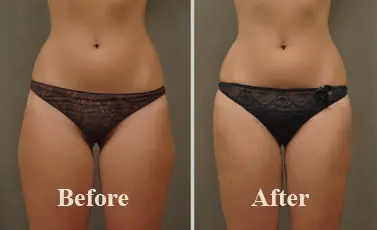 Thighs Liposuction Before After