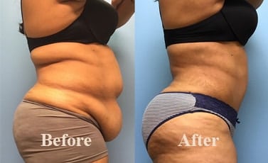Tummy Tuck Bhopal Before After